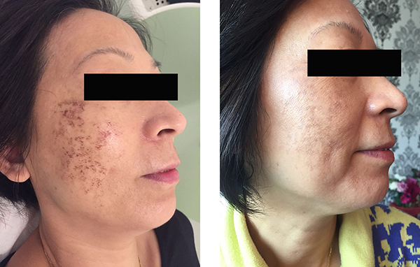 Pigmentation treatment Before and After