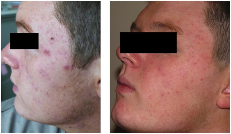 Acne treatment result man left face