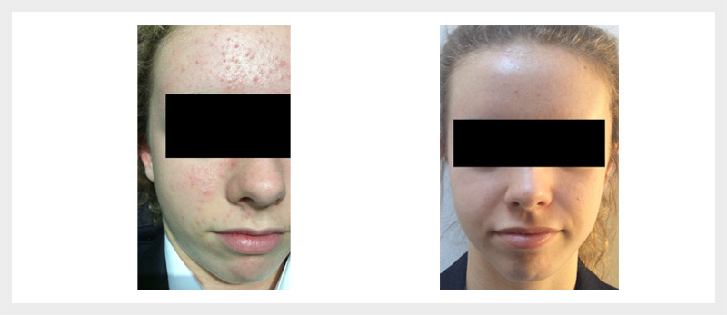 Dermalux LED Acne treatment