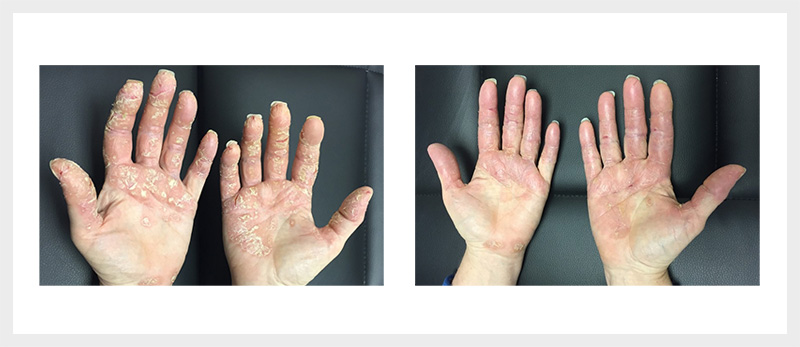 Dermalux LED Dermatitis treatment