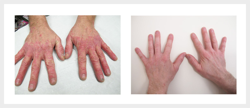 Dermalux LED Psoriasis treatment