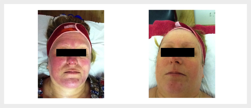 Dermalux LED Rosacea treatment